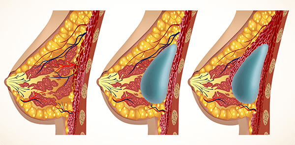 breast-enlargement-procedure