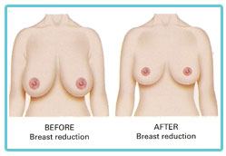 breast-reduction-surgery