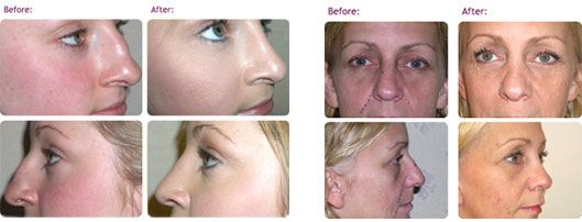 rhinoplasty-nose-job-before-after-photos