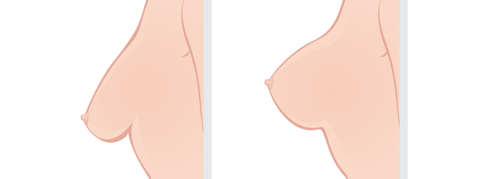 Breast-Uplift-Surgery