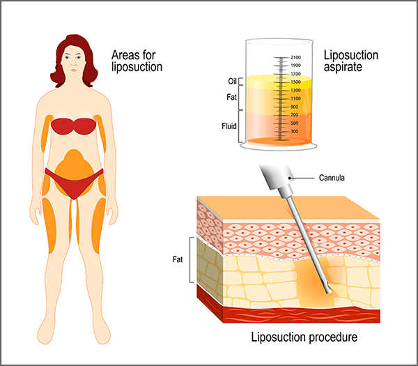 liposuction-procedure-target-areas