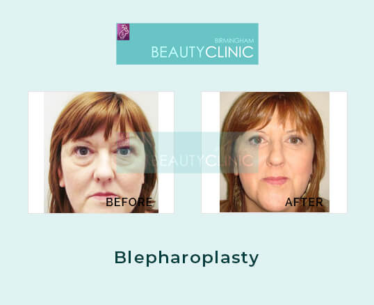 blepharoplasty - before and after