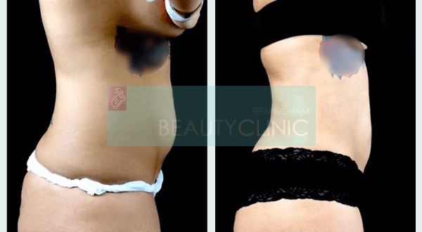 abdominoplasty before and after