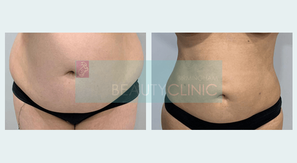 mini stomach liposuction before and after