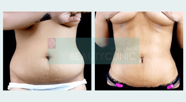 mini tummy tuck before and after