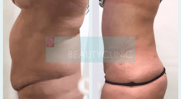 tummy tuck before and after