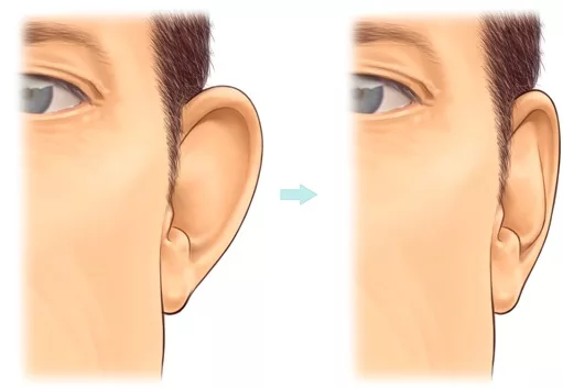 Ear-Correction