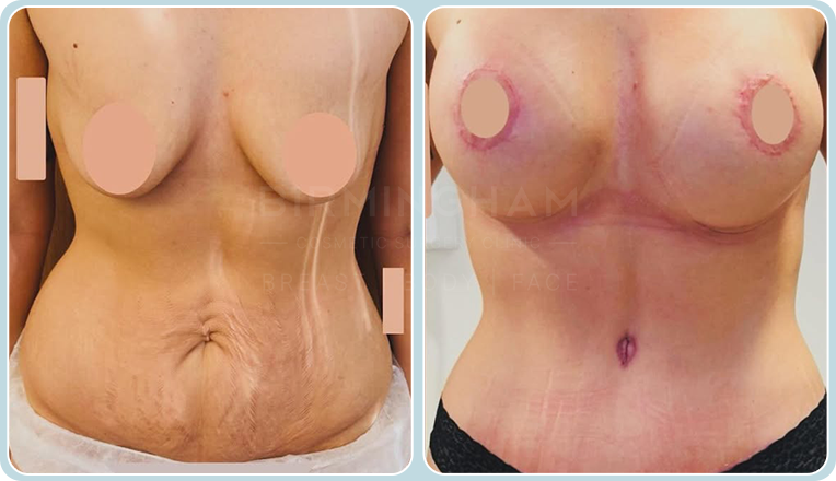 breast enhancement with an uplift and a tummy tuck
