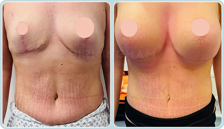 breast uplift and new breast augmentation plus tummy tuck-vaser liposuction