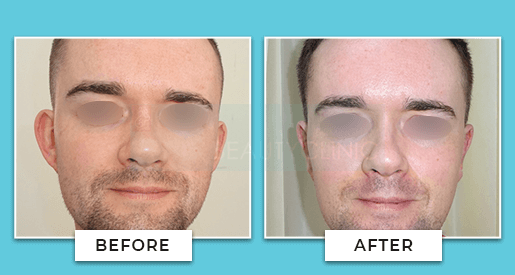 Ear Correction Before And After