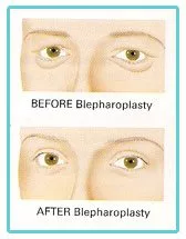 eye-lid-surgery-birmingham