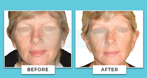 Facelift Before And After