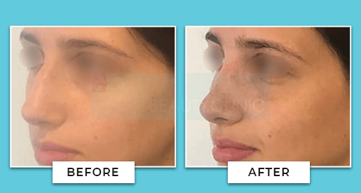 nose job before and after