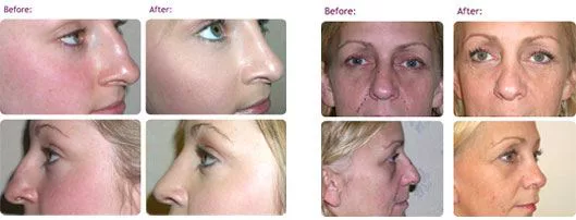 nose-job-rhinoplasty