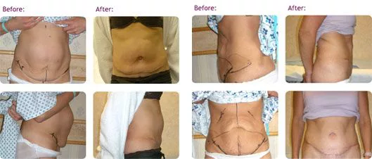 tummy-tuck-abdominoplasty
