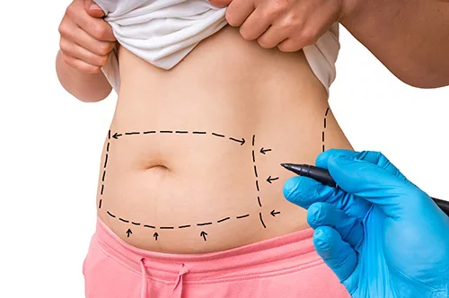 Tummy Tuck Adminoplasty