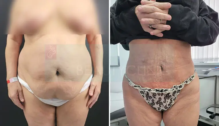 Vaser Lipo Before And After Stomach