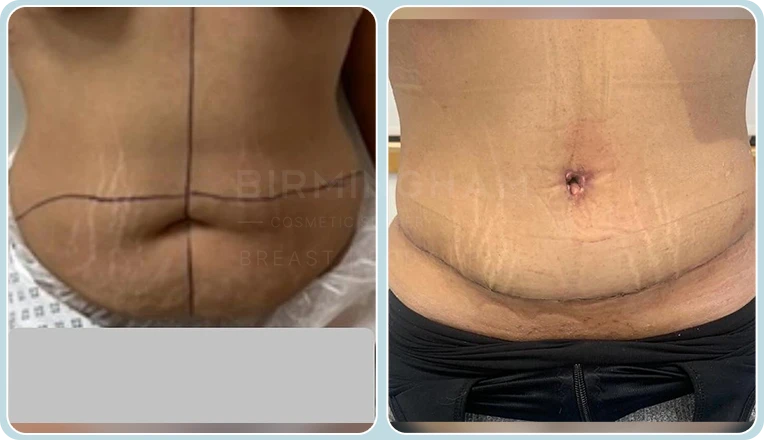 abdominoplasty before and after