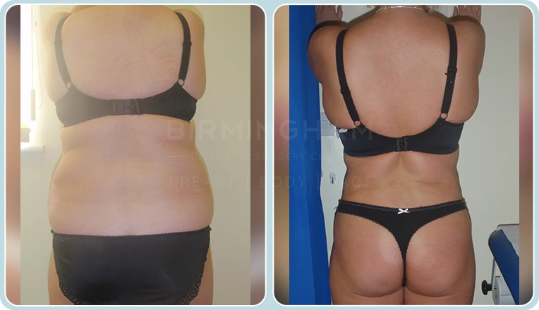 back vaser liposuction before and after result