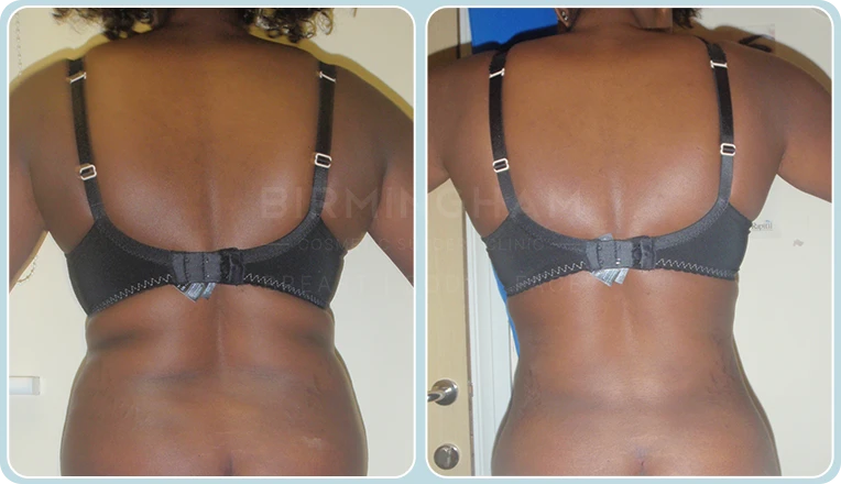 back vaser liposuction before and after result