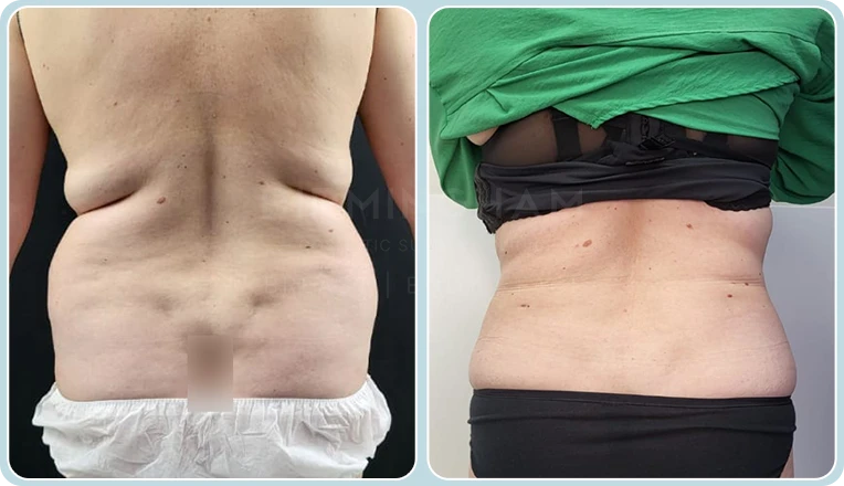 back vaser liposuction before and after result