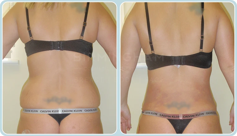 back vaser liposuction before and after result