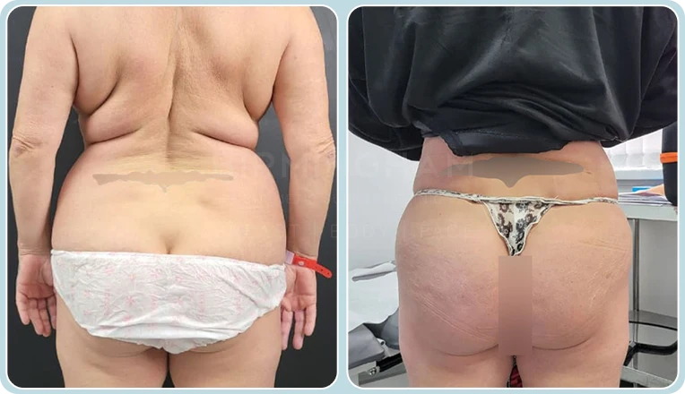back vaser liposuction before and after