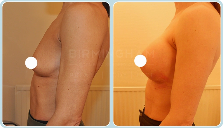 breast enlargement before and after result