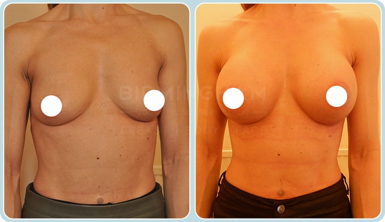 breast enlargement before and after result