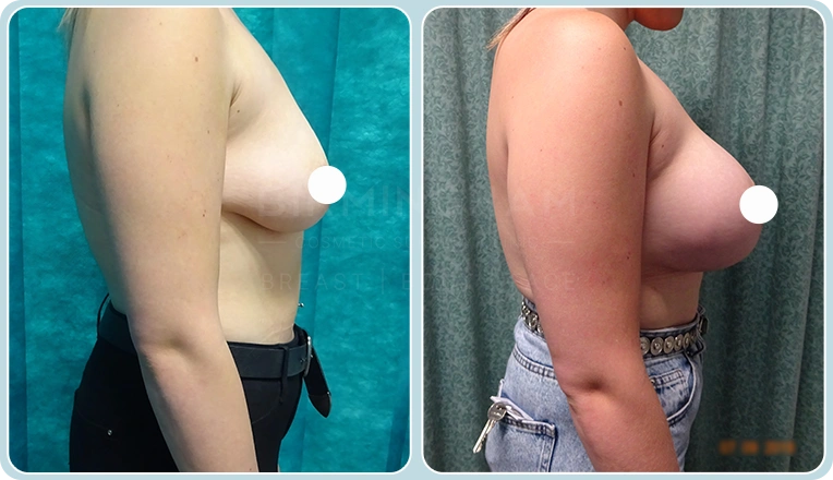 breast enlargement before and after result