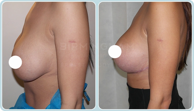breast lift before and after result