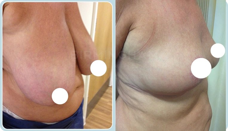 breast reduction before and after result