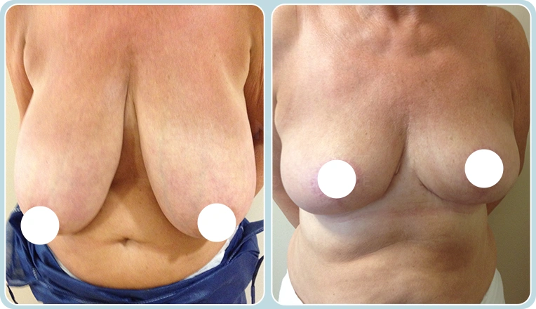 breast reduction before and after result