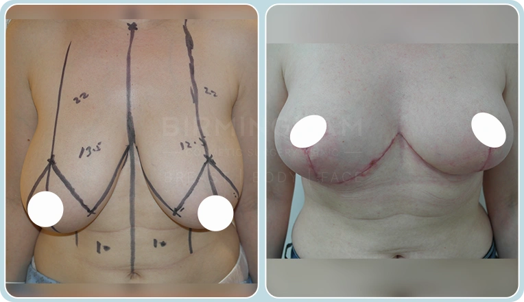 breast reduction before and after result
