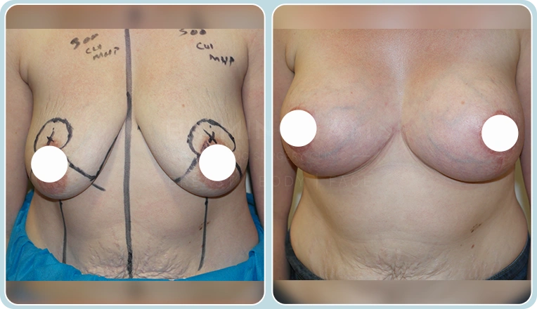 breast uplift before and after result