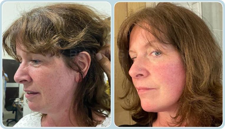 facelift before and after result