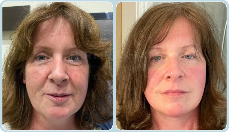 facelift before and after result