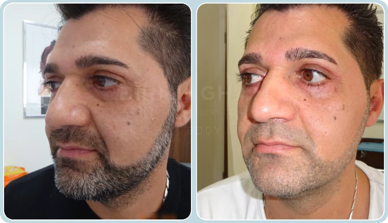 lower eyelid blepharoplasty before and after