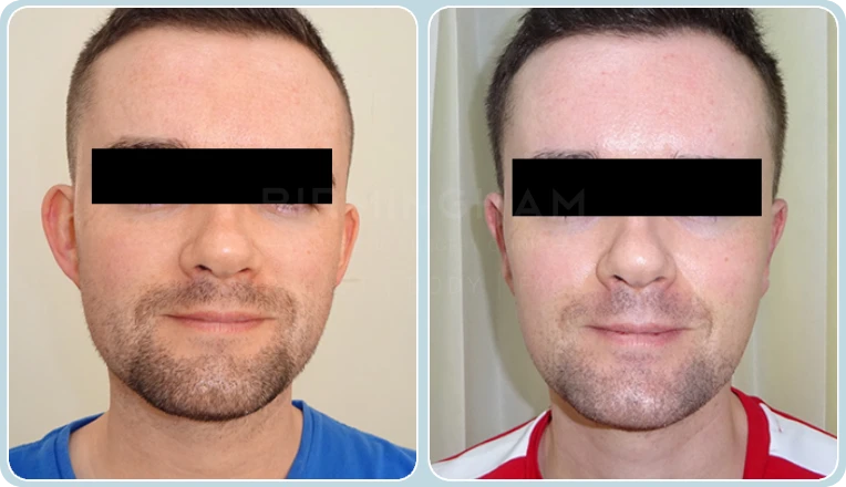 otoplasty before and after result