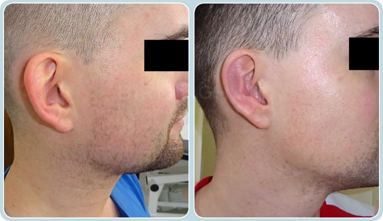 otoplasty before and after result