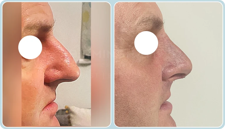 rhinoplasty before and after male patient