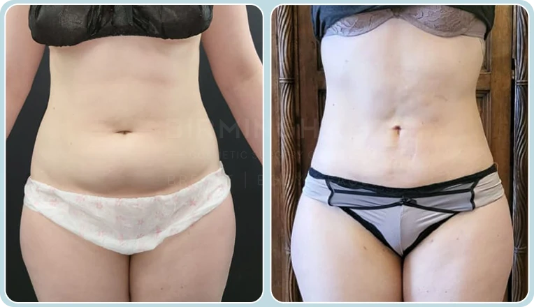stomach vaser lipo before and after result