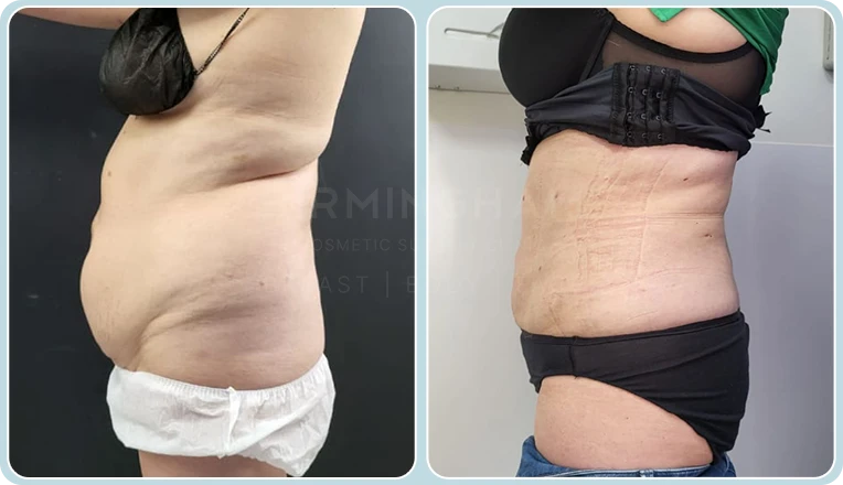vaser liposuction female abs before and after result